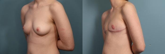 Gender Affirming Top Surgery Before & After Gallery - Patient 134529 - Image 2