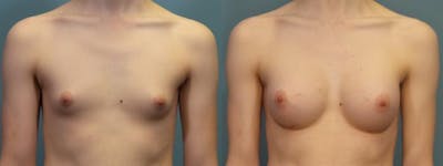 Gender Affirming Breast Augmentation Before & After Gallery - Patient 529088 - Image 1