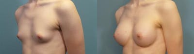 Gender Affirming Breast Augmentation Before & After Gallery - Patient 529088 - Image 2