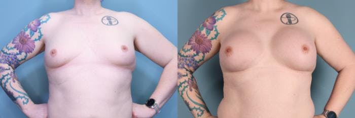 Gender Affirming Breast Augmentation Before & After Gallery - Patient 366524 - Image 1