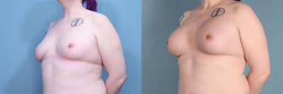 Gender Affirming Breast Augmentation Before & After Gallery - Patient 366524 - Image 2