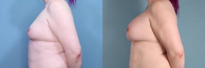 Gender Affirming Breast Augmentation Before & After Gallery - Patient 366524 - Image 3
