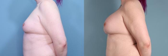 Gender Affirming Breast Augmentation Before & After Gallery - Patient 366524 - Image 3