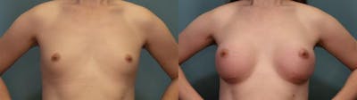 Gender Affirming Breast Augmentation Before & After Gallery - Patient 937751 - Image 1