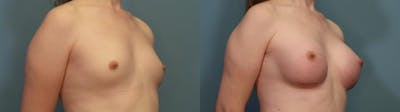 Gender Affirming Breast Augmentation Before & After Gallery - Patient 937751 - Image 2
