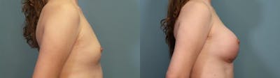 Gender Affirming Breast Augmentation Before & After Gallery - Patient 937751 - Image 3