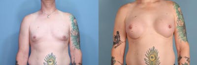 Gender Affirming Breast Augmentation Before & After Gallery - Patient 623277 - Image 1