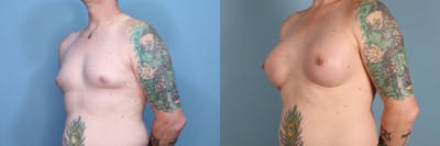 Gender Affirming Breast Augmentation Before & After Gallery - Patient 623277 - Image 2