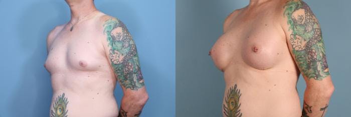 Gender Affirming Breast Augmentation Before & After Gallery - Patient 623277 - Image 2