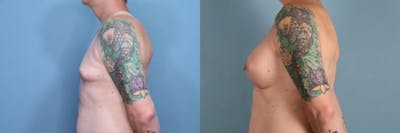 Gender Affirming Breast Augmentation Before & After Gallery - Patient 623277 - Image 3