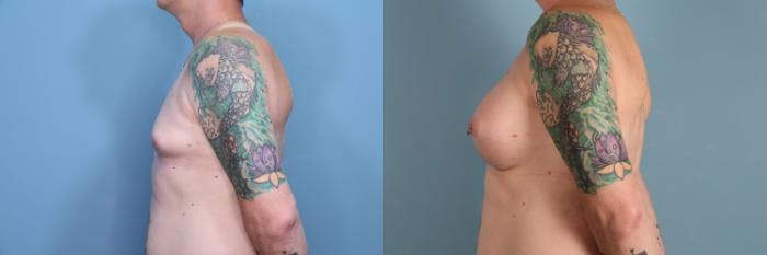Gender Affirming Breast Augmentation Before & After Gallery - Patient 623277 - Image 3