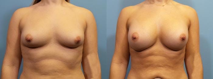 Breast Augmentation Before & After Gallery - Patient 534678 - Image 1