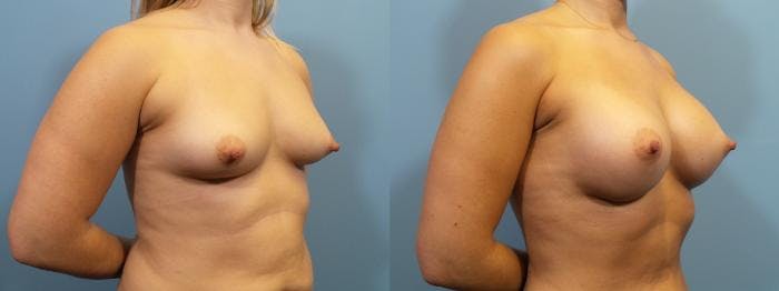 Breast Augmentation Before & After Gallery - Patient 534678 - Image 2