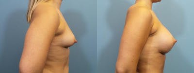 Breast Augmentation Before & After Gallery - Patient 534678 - Image 3