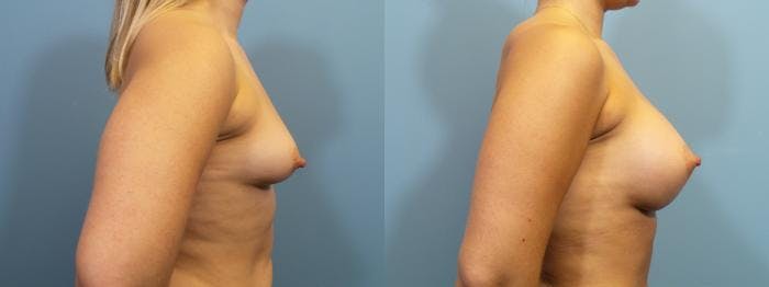 Breast Augmentation Before & After Gallery - Patient 534678 - Image 3