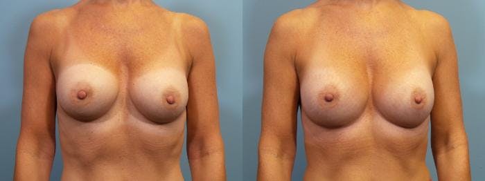 Breast Augmentation Before & After Gallery - Patient 126720 - Image 1