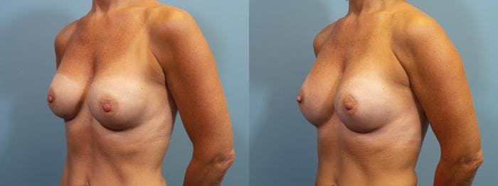 Breast Augmentation Before & After Gallery - Patient 126720 - Image 2