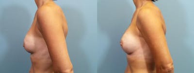 Breast Augmentation Before & After Gallery - Patient 126720 - Image 3