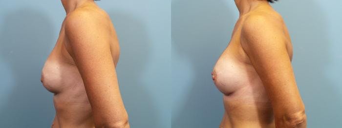 Breast Augmentation Before & After Gallery - Patient 126720 - Image 3