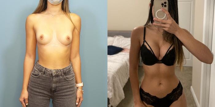 Breast Augmentation Before & After Gallery - Patient 196748 - Image 1