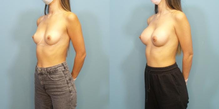 Breast Augmentation Before & After Gallery - Patient 196748 - Image 2