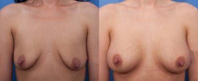 Breast Augmentation Before & After Gallery - Patient 410424 - Image 1