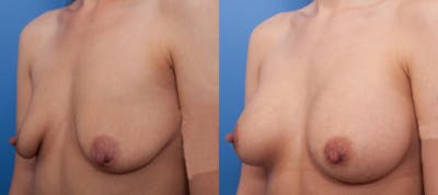 Breast Augmentation Before & After Gallery - Patient 410424 - Image 2