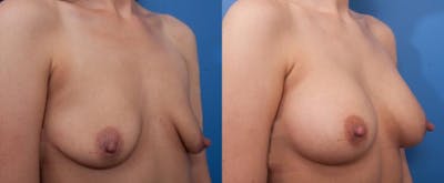Breast Augmentation Before & After Gallery - Patient 410424 - Image 3