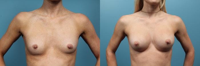 Breast Augmentation Before & After Gallery - Patient 555929 - Image 1
