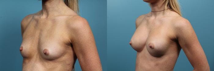 Breast Augmentation Before & After Gallery - Patient 555929 - Image 2