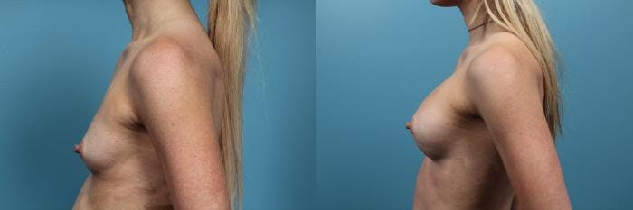 Breast Augmentation Before & After Gallery - Patient 555929 - Image 3