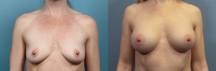 Breast Augmentation Before & After Gallery - Patient 149757 - Image 1