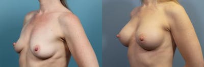 Breast Augmentation Before & After Gallery - Patient 149757 - Image 2