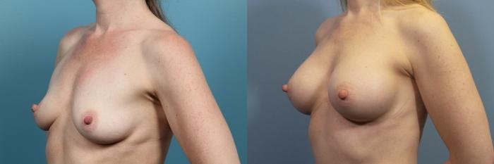 Breast Augmentation Before & After Gallery - Patient 149757 - Image 2