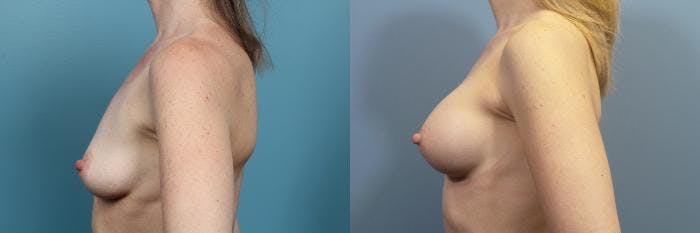Breast Augmentation Before & After Gallery - Patient 149757 - Image 3