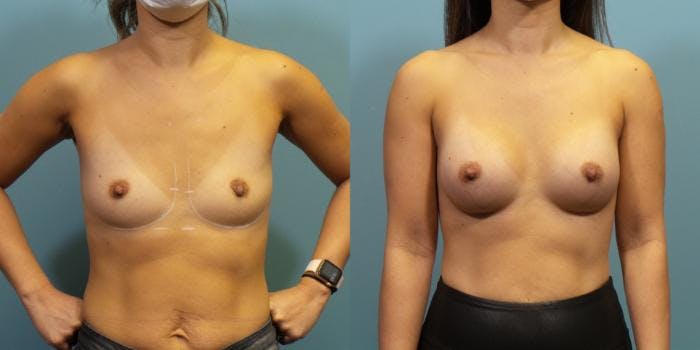 Breast Augmentation Before & After Gallery - Patient 144819 - Image 1