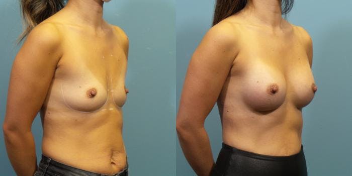 Breast Augmentation Before & After Gallery - Patient 144819 - Image 2