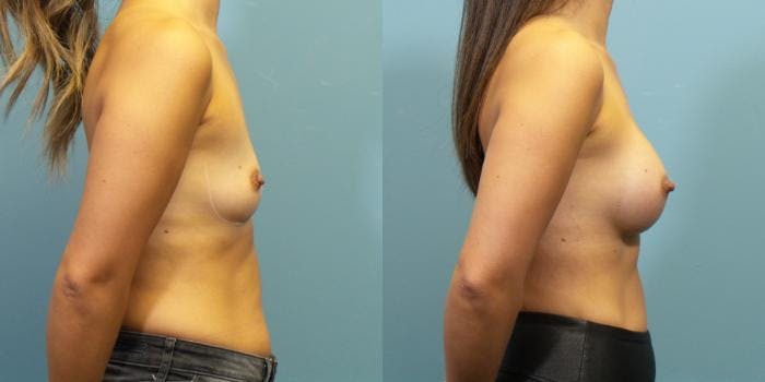 Breast Augmentation Before & After Gallery - Patient 144819 - Image 3