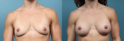 Breast Augmentation Before & After Gallery - Patient 309739 - Image 1