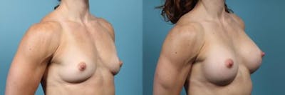 Breast Augmentation Before & After Gallery - Patient 309739 - Image 2