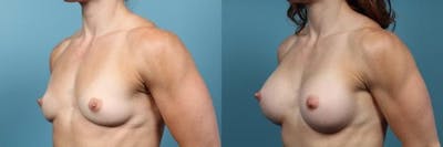 Breast Augmentation Before & After Gallery - Patient 309739 - Image 3