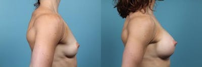 Breast Augmentation Before & After Gallery - Patient 309739 - Image 4