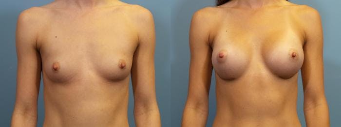 Breast Augmentation Before & After Gallery - Patient 201957 - Image 1