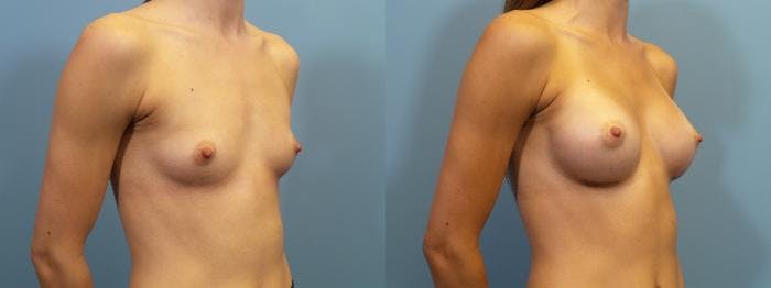 Breast Augmentation Before & After Gallery - Patient 201957 - Image 2