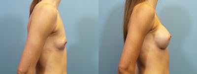 Breast Augmentation Before & After Gallery - Patient 201957 - Image 3