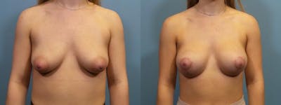 Breast Augmentation Before & After Gallery - Patient 230677 - Image 1