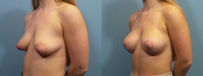 Breast Augmentation Before & After Gallery - Patient 230677 - Image 2