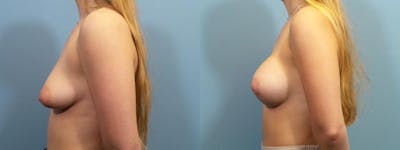Breast Augmentation Before & After Gallery - Patient 230677 - Image 3