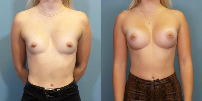 Breast Augmentation Before & After Gallery - Patient 342260 - Image 1