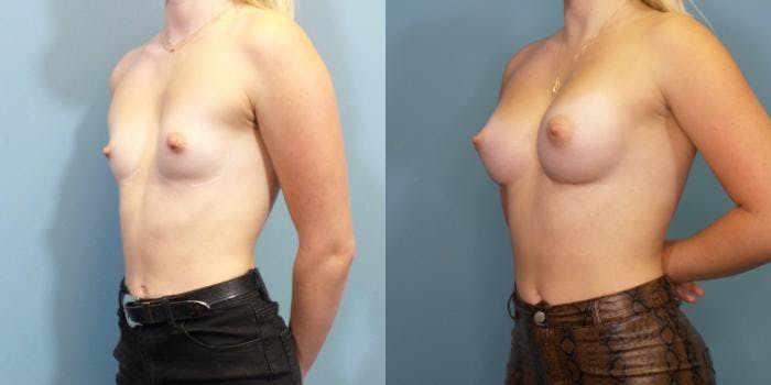 Breast Augmentation Before & After Gallery - Patient 342260 - Image 2